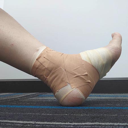 Treating Plantar Fasciitis With Kinesiology Tape